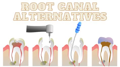 how to reverse a root chanel|avoiding a root canal.